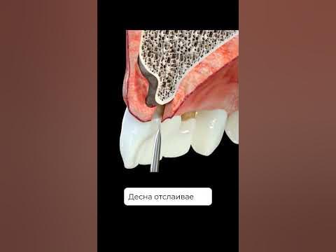 Зачем проводится открытый кюретаж? И что это за методика? - YouTube