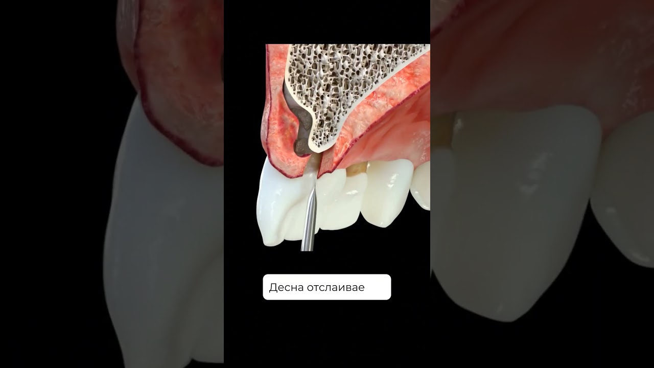 Зачем проводится открытый кюретаж? И что это за методика?