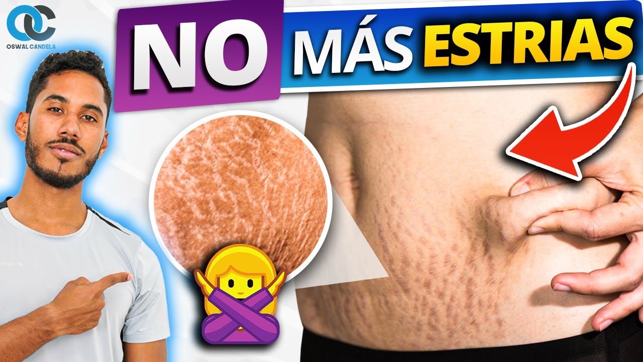 Cómo quitar y mejorar las ESTRÍAS - GUÍA DEFINITIVA - YouTube