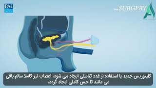 انیمیشن انجام جراحی تغییر جنسیت در ایران
