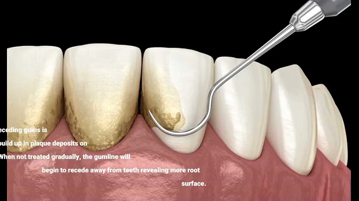 What Causes Receding Gums?