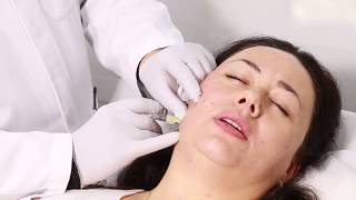 Injections with Hyaluronic acid Apriline
