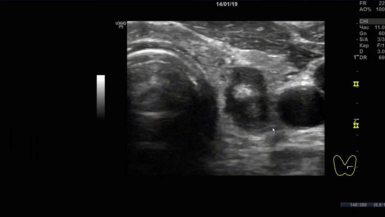 Обучение узи ultrasonicthyroid ru. Паращитовидные железы на УЗИ фото. Аденома щитовидной железы на УЗИ. Аденома паращитовидной железы на УЗИ. Как выглядит киста на снимке УЗИ.