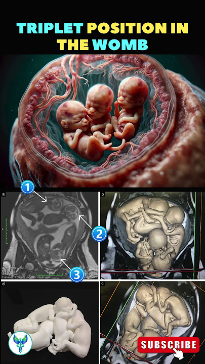 Understanding Triplet Positioning in the Womb | Triplets | Fetal development #shortsfeed #pregnancy