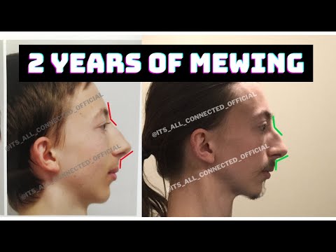 3 Effecative Mewing Effecative Mewing:Before And A by jawlinerfitness on  DeviantArt