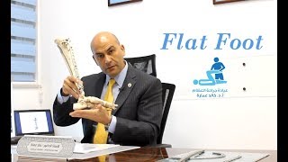 flat foot  | تفلطح القدم - أد. خالد عمارة