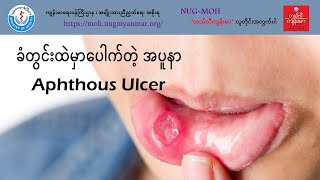 ခံတွင်းထဲမှာပေါက်တဲ့အပူနာ (Aphthous Ulcer)