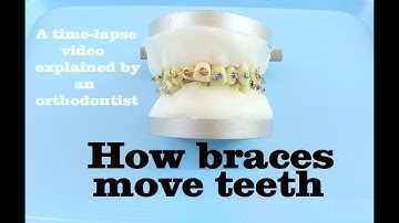 Ever Wonder How Braces Work? Find Out Here!