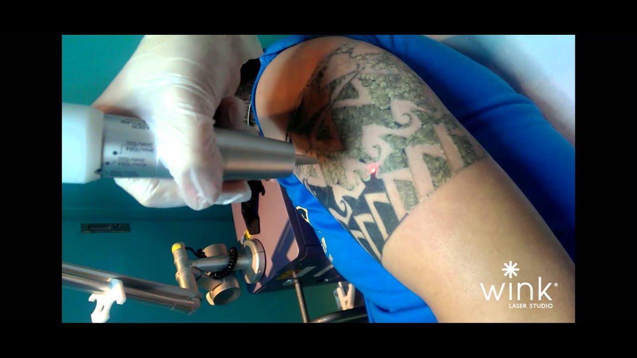 Details 52+ revlite tattoo removal best