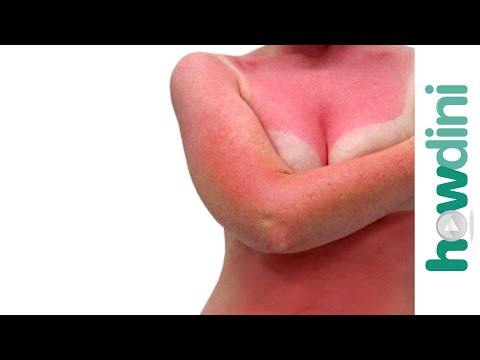 Quick sunburn relief - Sunburn treatment and remedies