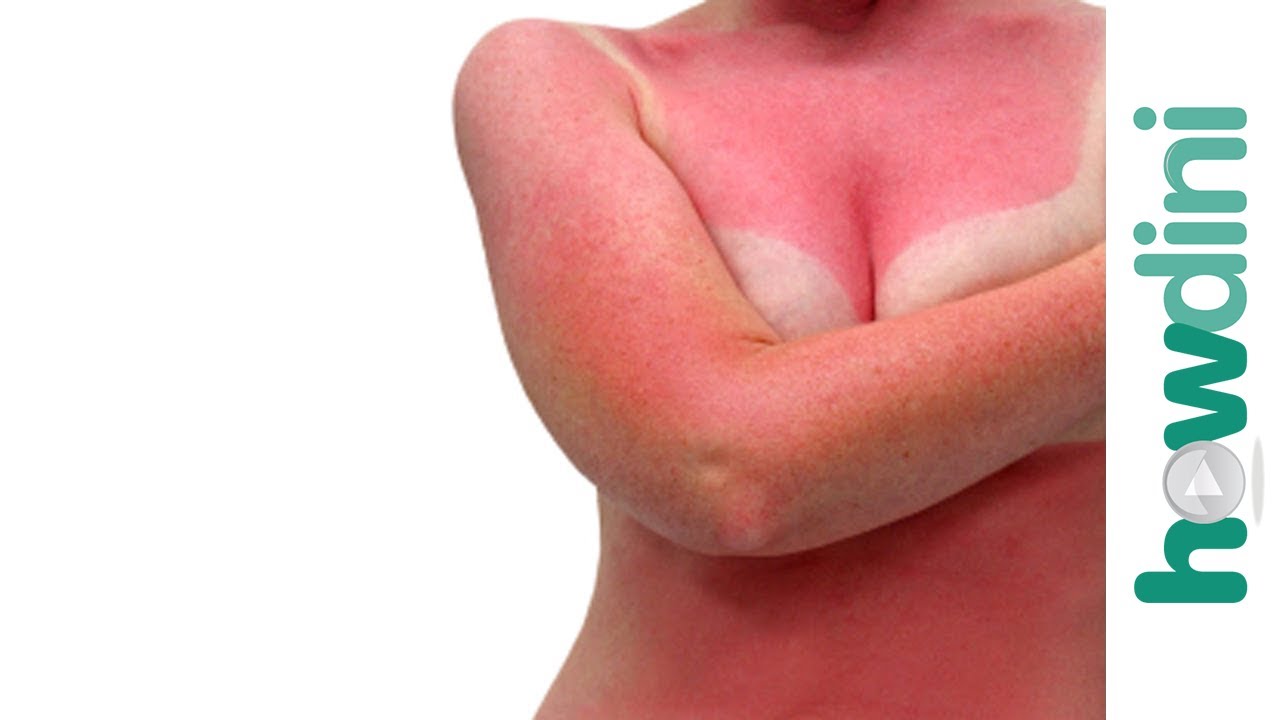 Quick sunburn relief - Sunburn treatment and remedies 