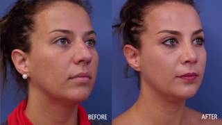 RHINOPLASTY IN TEXAS::PLASTIC AND COSMETIC SURGERY