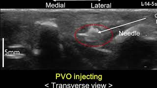 Hydrogen peroxide-responsive nanoparticles in sciatic neuritis – Supplementary Video S1 [447691]