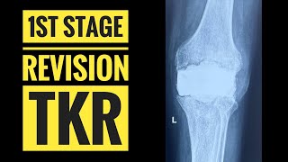 1st Stage Revision TKR(Detailed Surgical Technique)