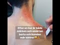 Gua sha the best treatment for pain