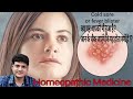 Homeopathic Medicine for fever blister ? Cold sores | Herpes labialis