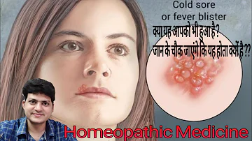 Homeopathic Medicine for fever blister ? Cold sores | Herpes labialis