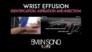 Wrist Effusion - Identification, Aspiration and Injection