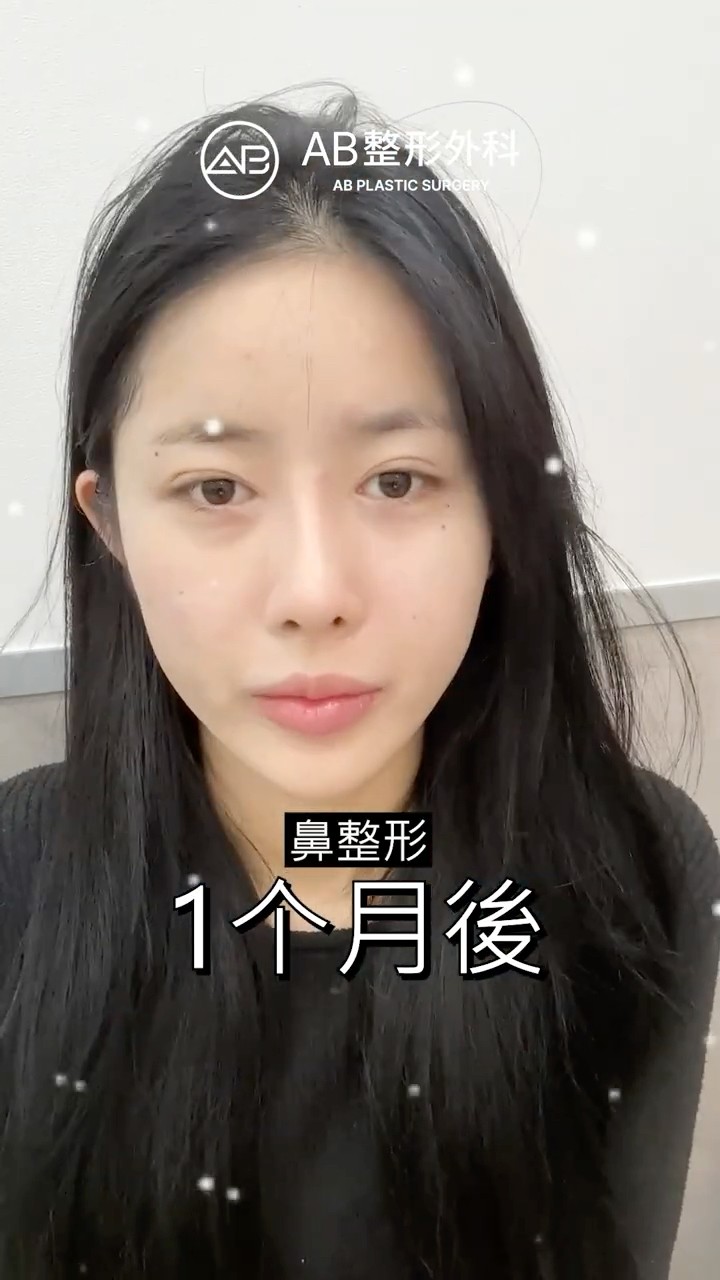 超自然隆鼻，這才是成功案例 #shorts
