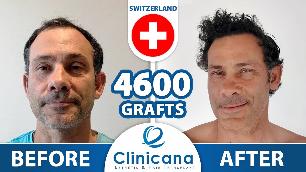 Hair transplant review from Switzerland after hair transplantation in Istanbul Turkey | Clinicana