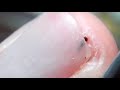 Sea urchin spine removal under My finger nail.