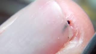 Sea urchin spine removal under My finger nail.