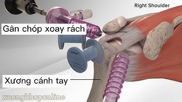 Nội soi khớp vai khâu gân chóp xoay bị rách