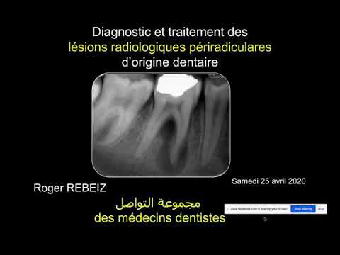 Vidéo: Parodontite Apicale - Symptômes, Traitement, Formes, Stades, Diagnostic