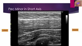 SubPectoral Ultrasound Workshop screenshot 5