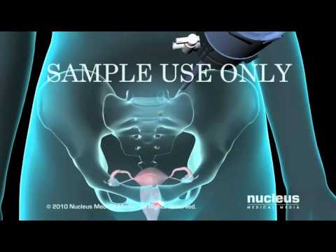 Tubal Ligation Tubes Tied Surgery - YouTube