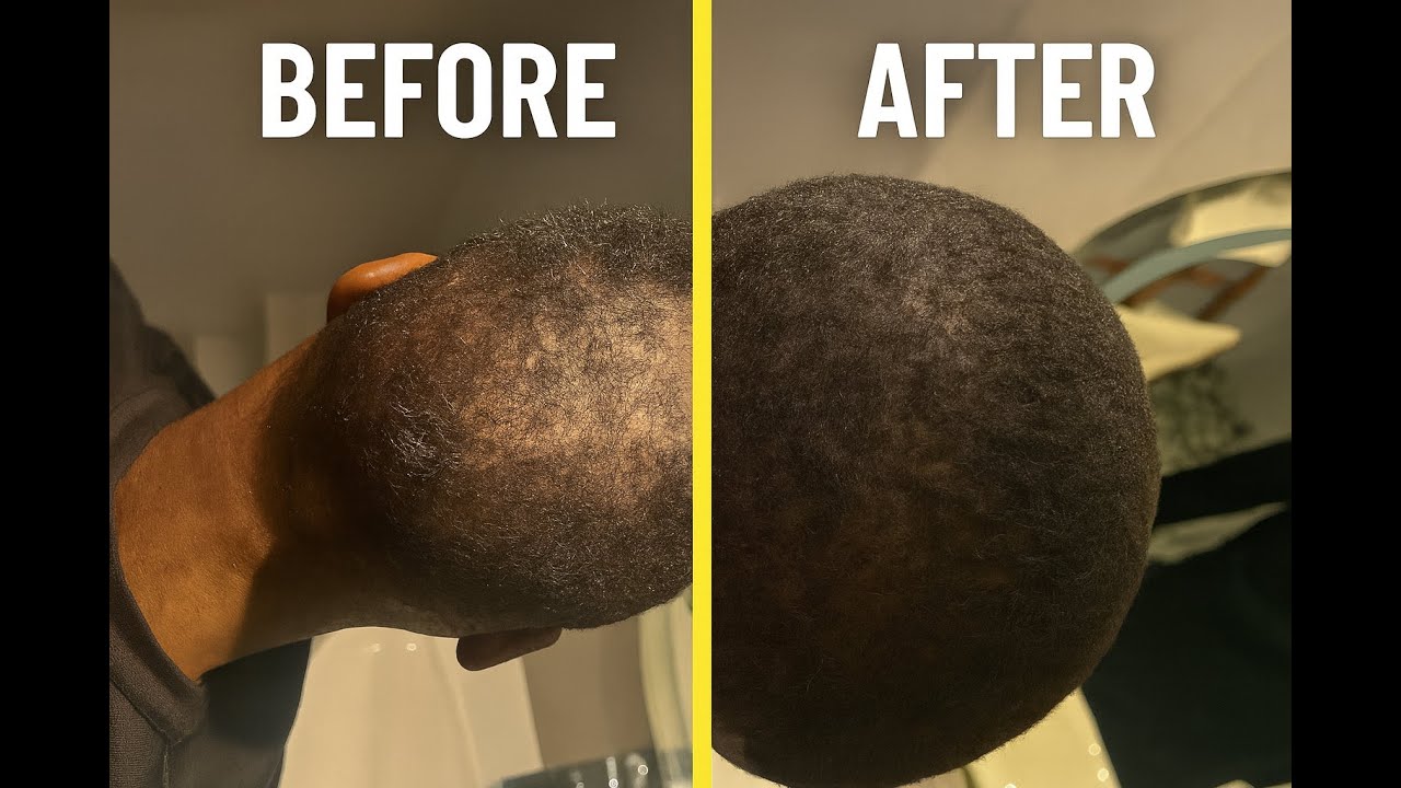 Natural Ways to Stop Balding and Regrow Hair 🌱