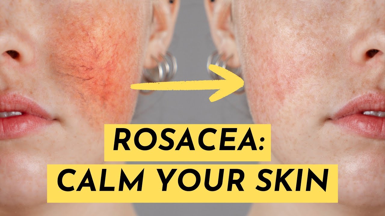 ROSACEA: How To Treat Flare-Ups With Skincare Hacks That Work! 😌