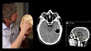 Paranasal sinuses CT imaging anatomy