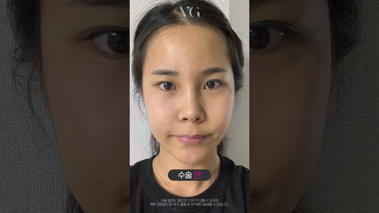 [Bệnh viện phẫu thuật thẩm mỹ Very Good] Nhìn sống mũi thật sắc sảo.