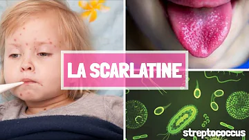 Comment savoir si on a la scarlatine ?