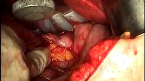 Qual a diferença entre a cirurgia bypass e Capella?