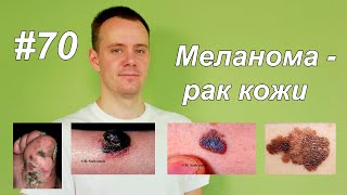 МЕЛАНОМА - РАК КОЖИ