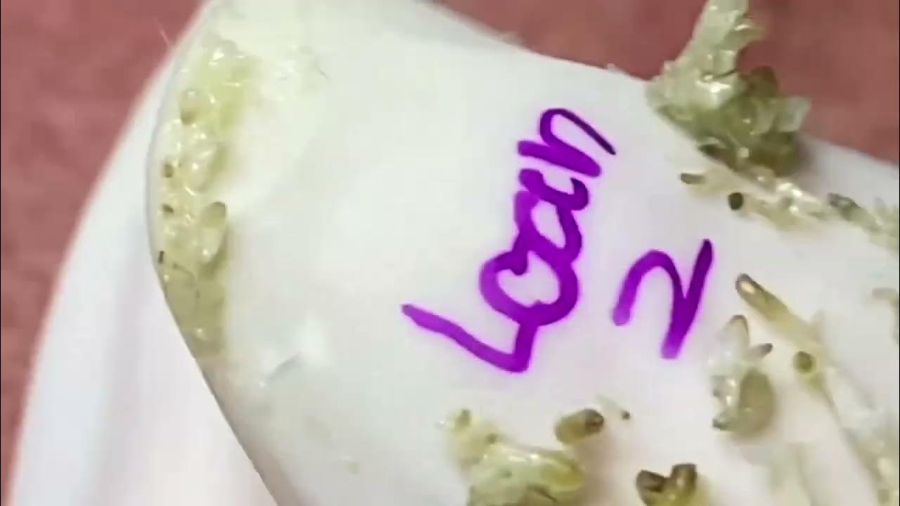 Extreme blackhead Removal at SRN Skin Care enilsa brown 1012 YouTube