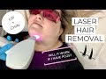 I GOT LASER HAIR REMOVAL ON MY LIP AND CHIN | PCOS | SPADERMA CHICAGO