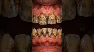 TRANSFORMATION: Years of Smoking Stains Erased! 🦷✨ #Shorts #DentalRestoration