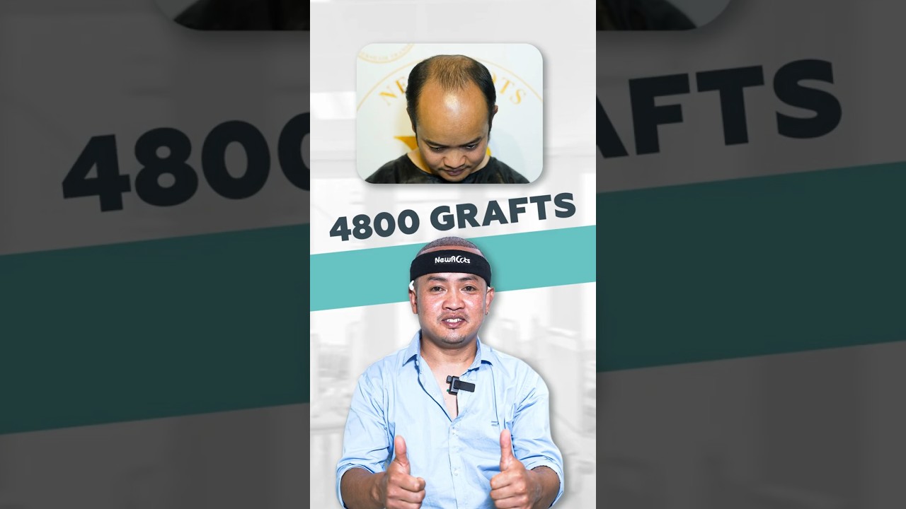 Hair Transplant Surgery in Siliguri | Baldness Treatment | New Roots 