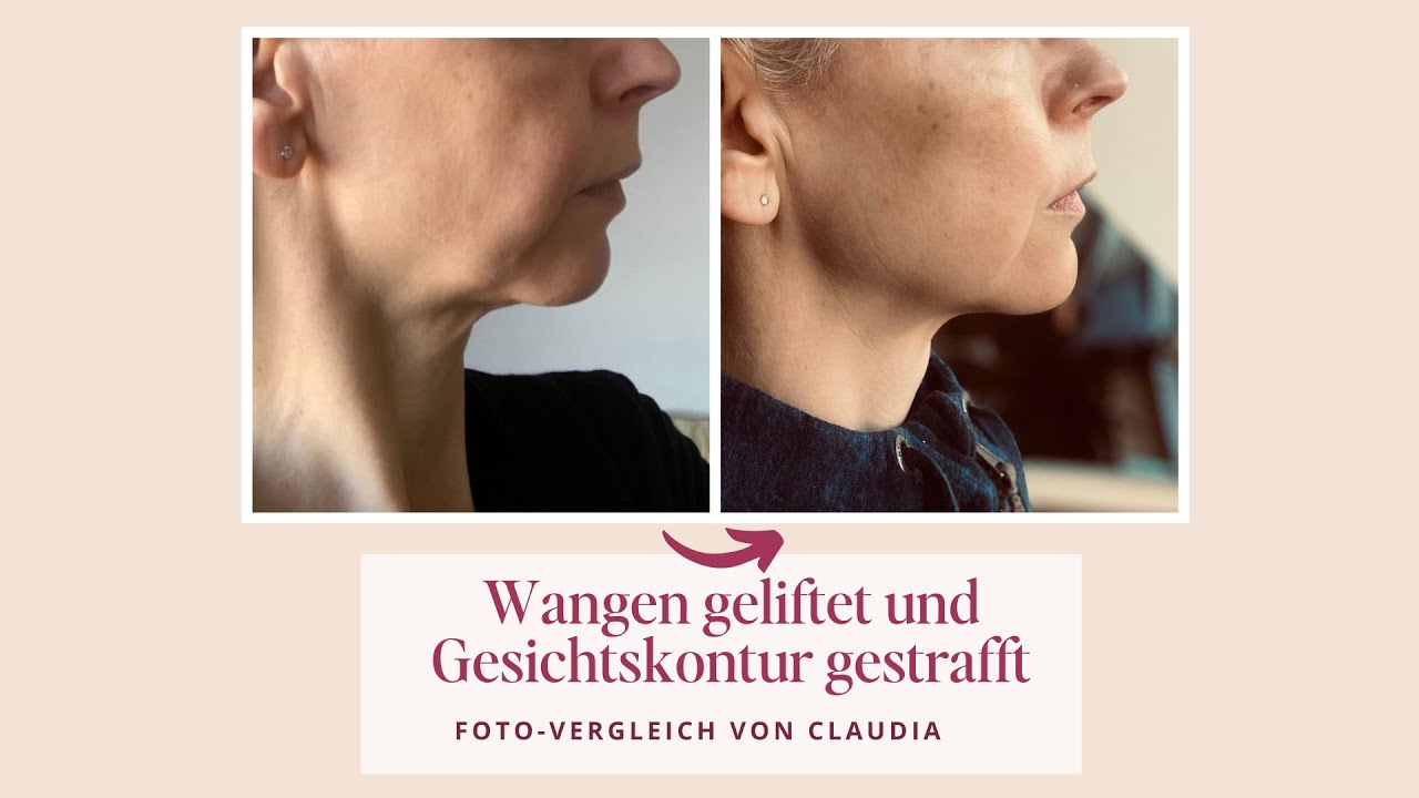 Wangen geliftet und Kinnlinie gestrafft - Fotovergleich von Claudia