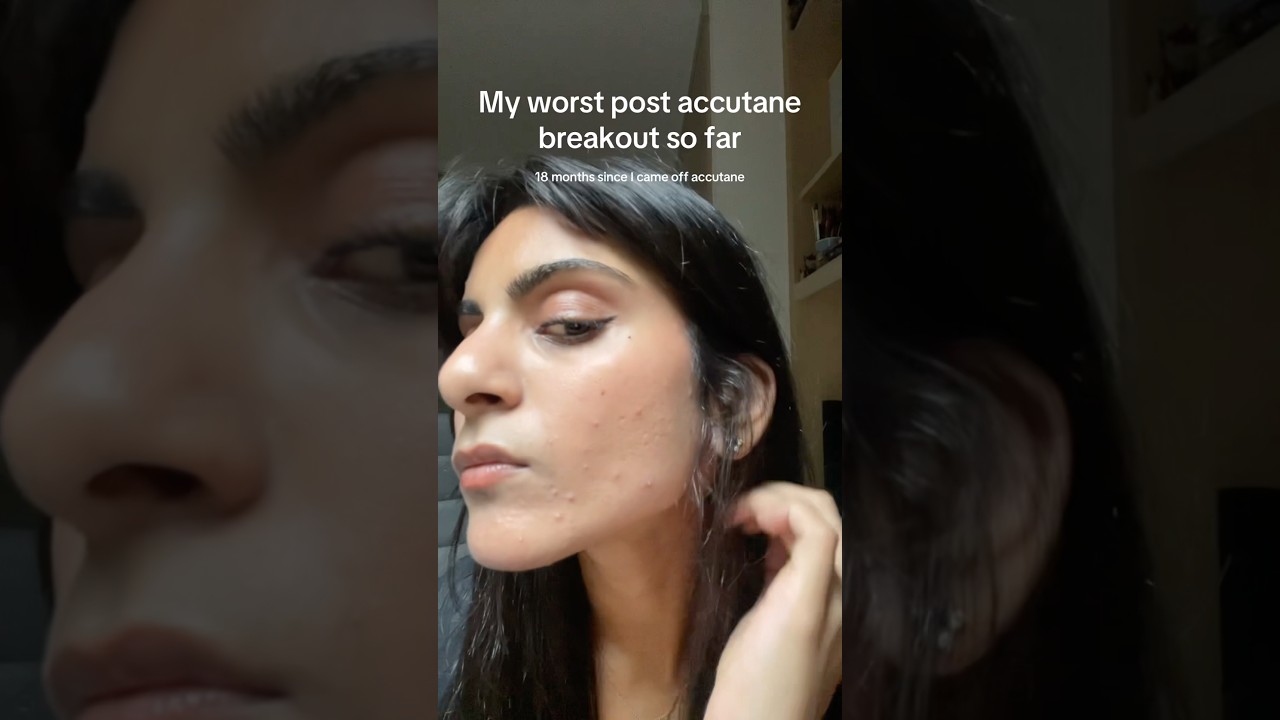 The worst breakout I’ve had since coming off Accutane 18 months ago 