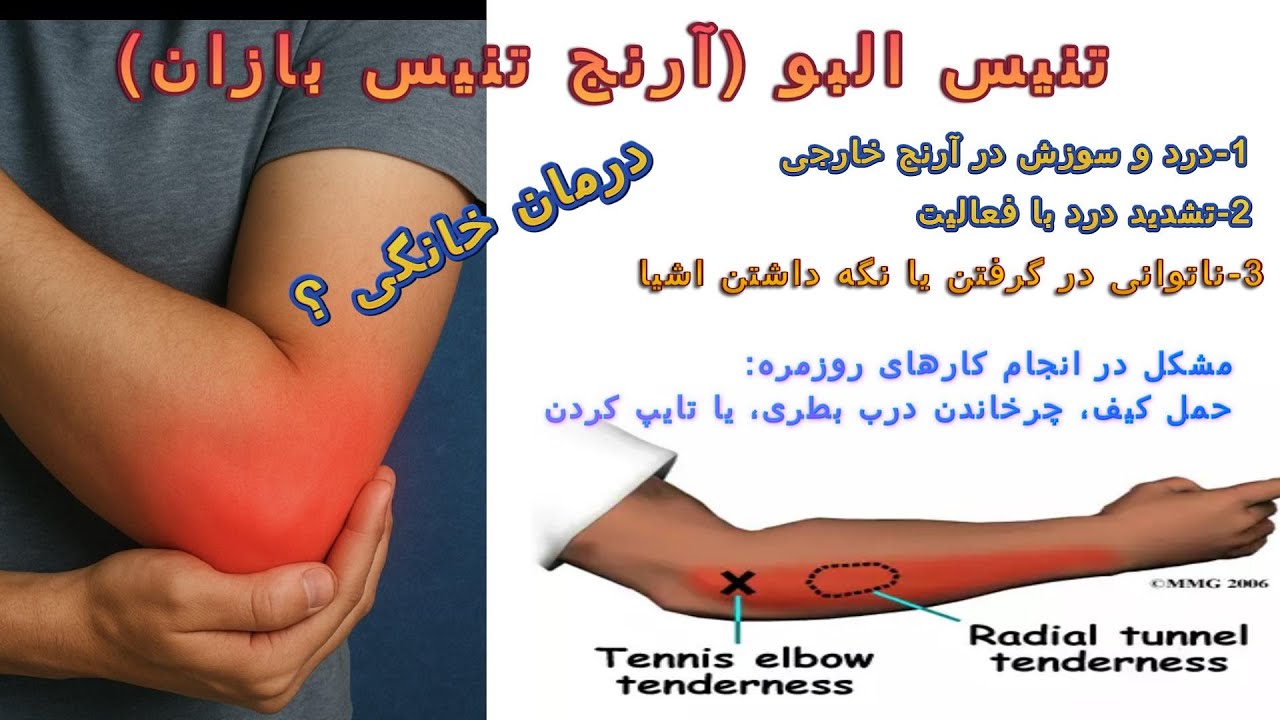 تنیس‌اِلبو:  درد از آرنج تا مچ!  علت و درمان کامل