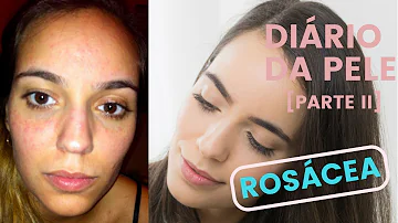Quem tem rosácea pode usar Azelan?