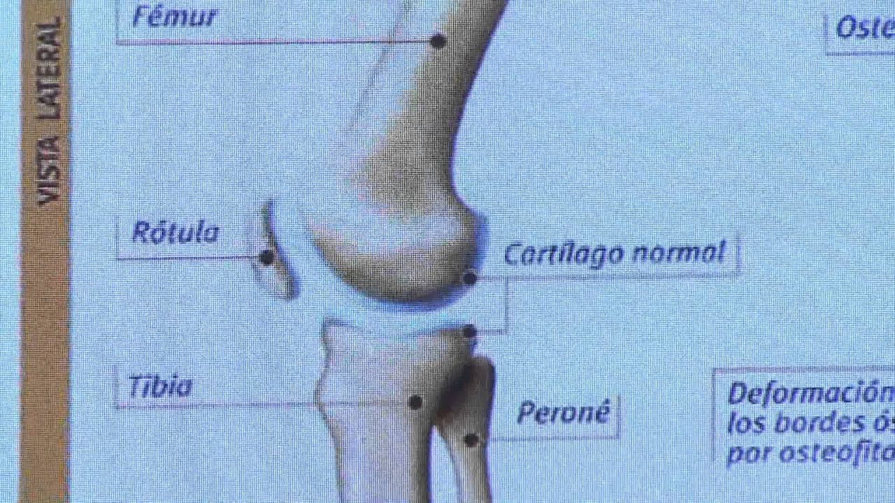 camera iphone 8 plus apk Los buenos años 12 ARTROSIS DE RODILLA
