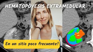 ¡Esto sí que es poco frecuente! 😮 Hematopoyesis extramedular… RENAL! Todo lo que podés ver en TC!💥