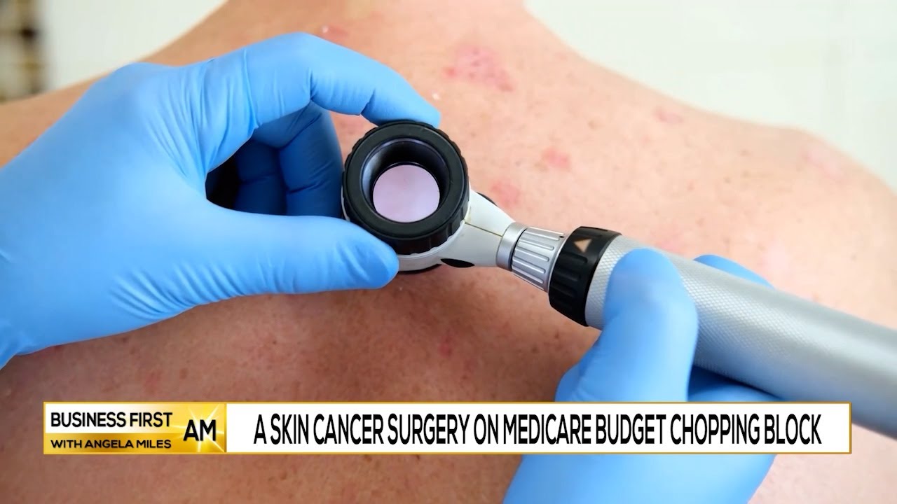 A Skin Cancer Surgery on Medicare Budget Chopping Block - YouTube