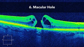 6. Macular Hole MH