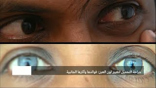 جراحة التجميل لتغيير لون العيون: مميزات العملية ومخاطرها screenshot 4